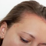 seborrheic dermatitis on a young woman's hairline