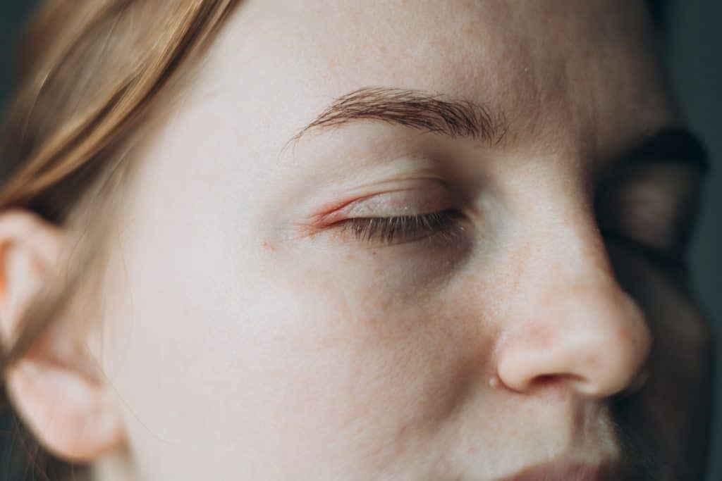 eczema cream for face and eyelids on sensitive skin