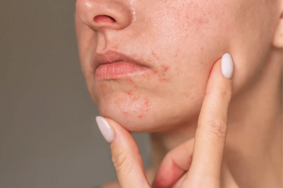 Red rash and bumps around the mouth consistent with perioral dermatitis