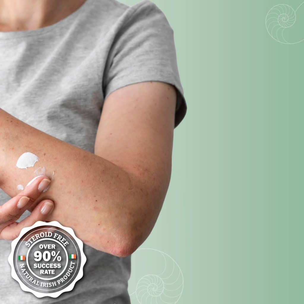 Man applying natural eczema cream