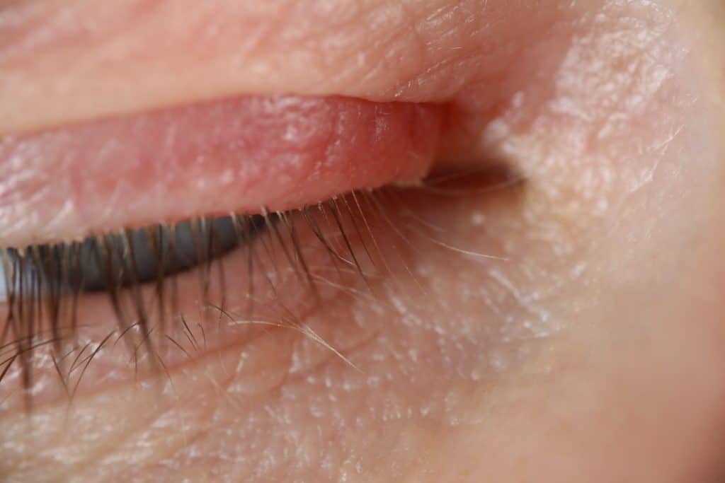 ​​eyelid eczema, eczema around eyes, eyelid rash treatment, dry eyelid skin, sensitive skin on eyelids, soothe eyelid eczema, eyelid rash, eczema around eyes, eye dermatitis, eyelid itching,