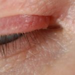 ​soothe eyelid eczema, eyelid rash, eczema around eyes, eye dermatitis, eyelid itching,
