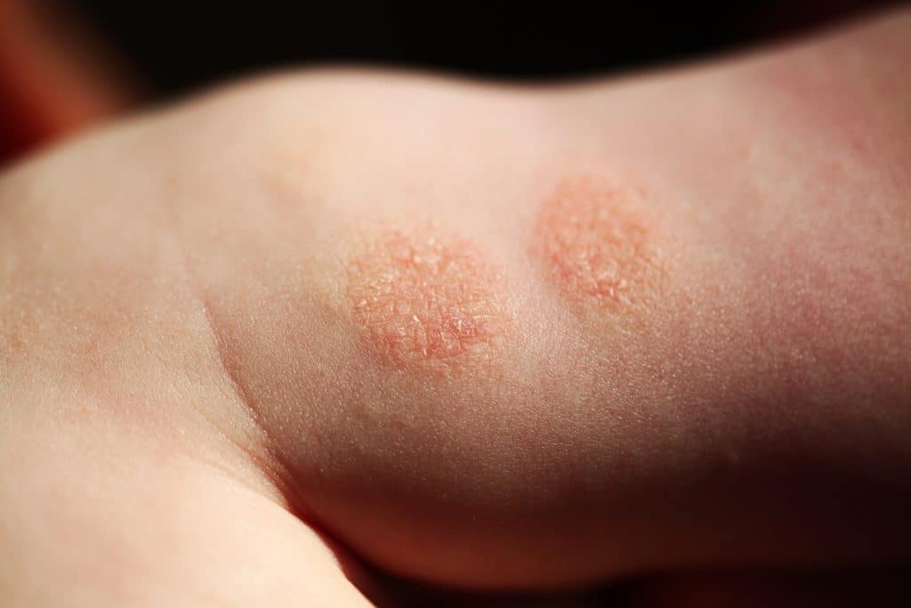 types of eczema