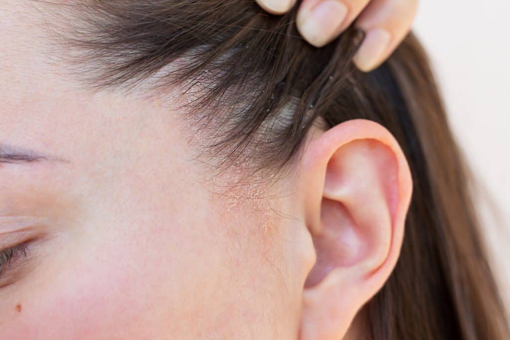 Dry scalp vs itchy scalp comparison showing symptoms and differences