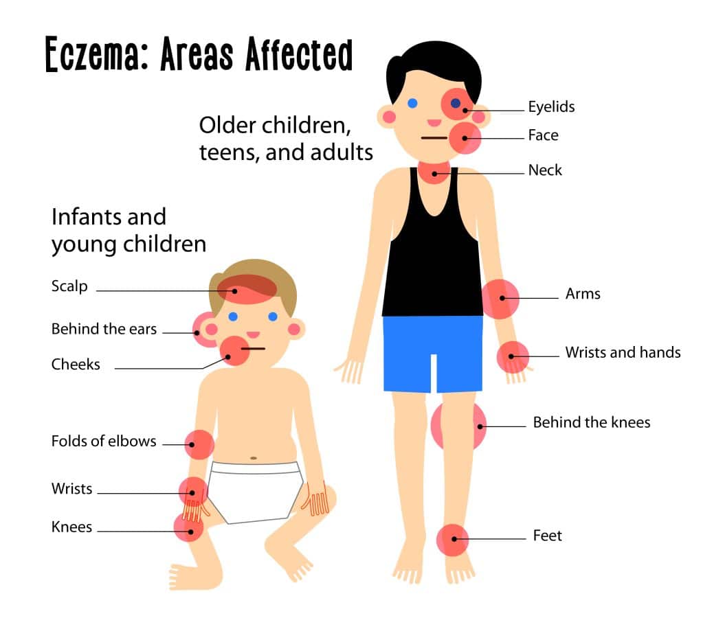 types of eczema Ireland – areas of the body affected by eczema