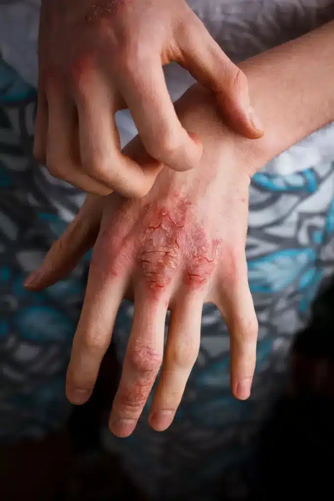 contact dermatitis rash on hands