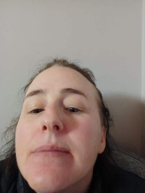 Lorraine's face after using the atopic cream