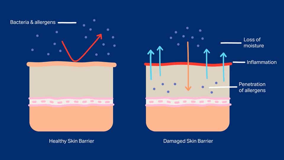 Illustration showing how a weakened skin barrier can lead to irritation in sensitive intimate skin.