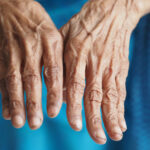 Psoriatic Arthritis fingers