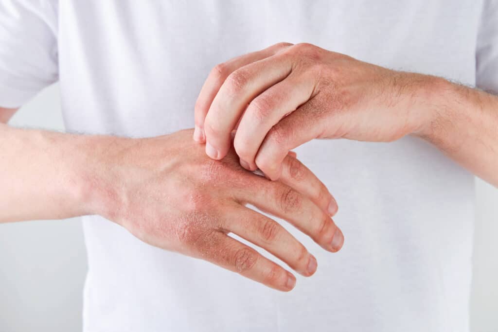 psoriasis on the hands