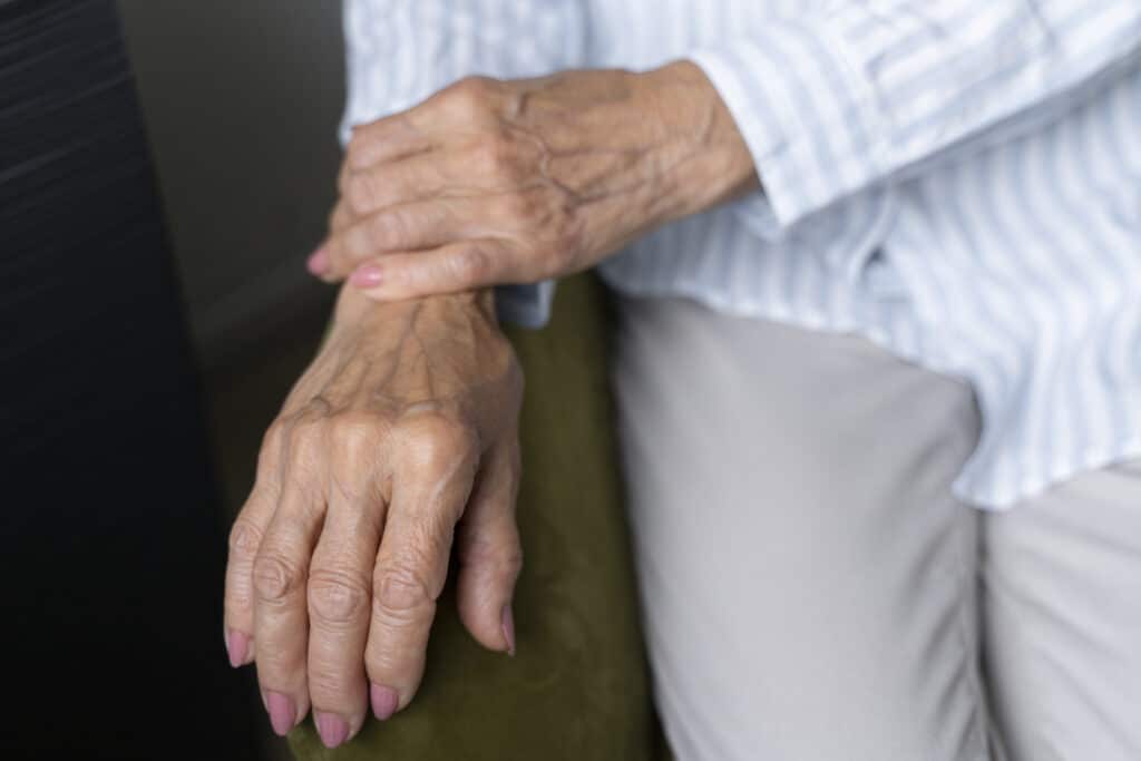 Living with psoriatic arthritis and sensitive skin during flare-ups
