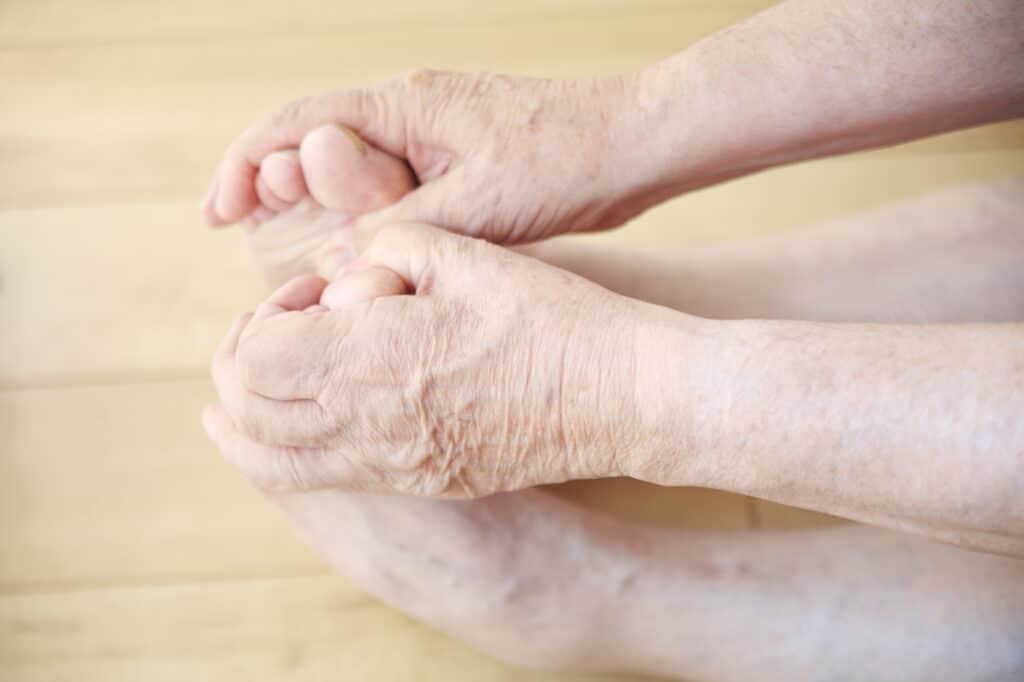 Psoriatic arthritis toes