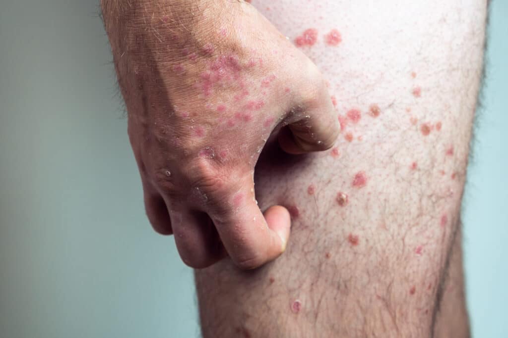 psoriasis on the leg