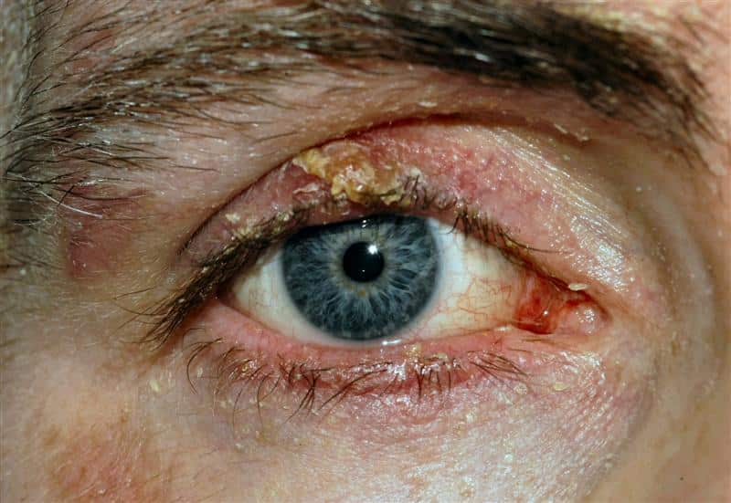 Blepharitis