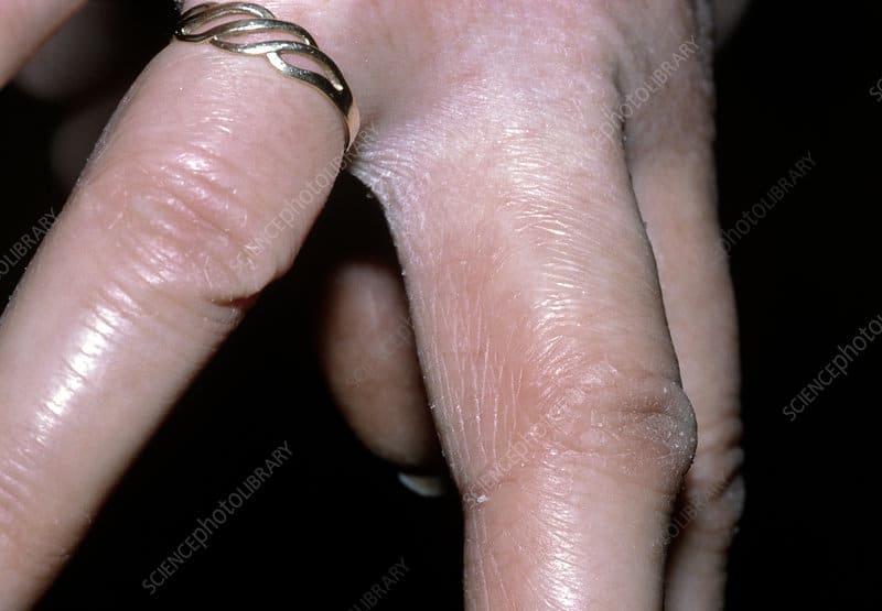 Contact dermatitis between fingers due to repeated exposure to detergents