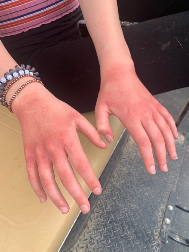 Red irritated skin on hands caused by contact dermatitis from cleaning products