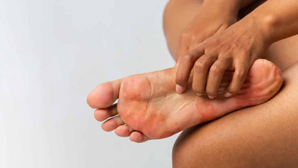 Dyshidrotic eczema on the foot