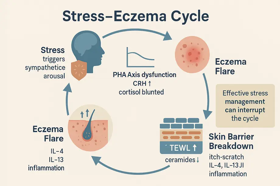 How stress can trigger eczema flare-ups