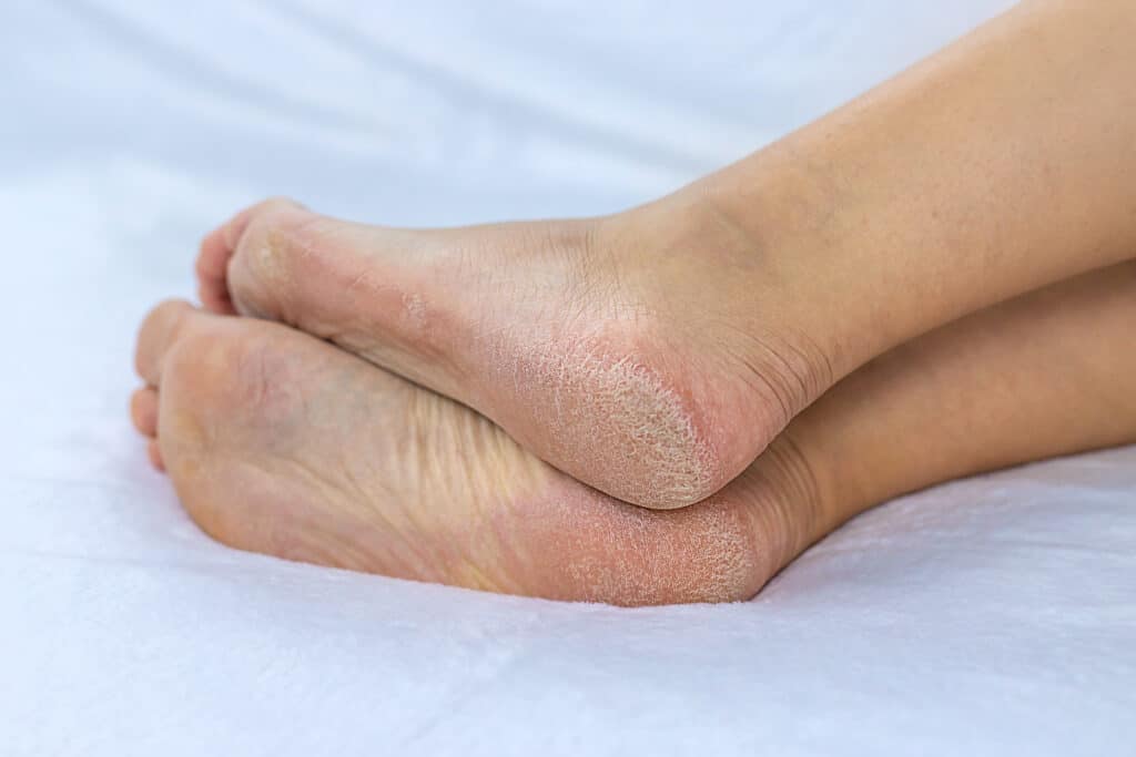 Dyshidrotic Eczema on Feet