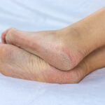 Dyshidrotic Eczema on Feet