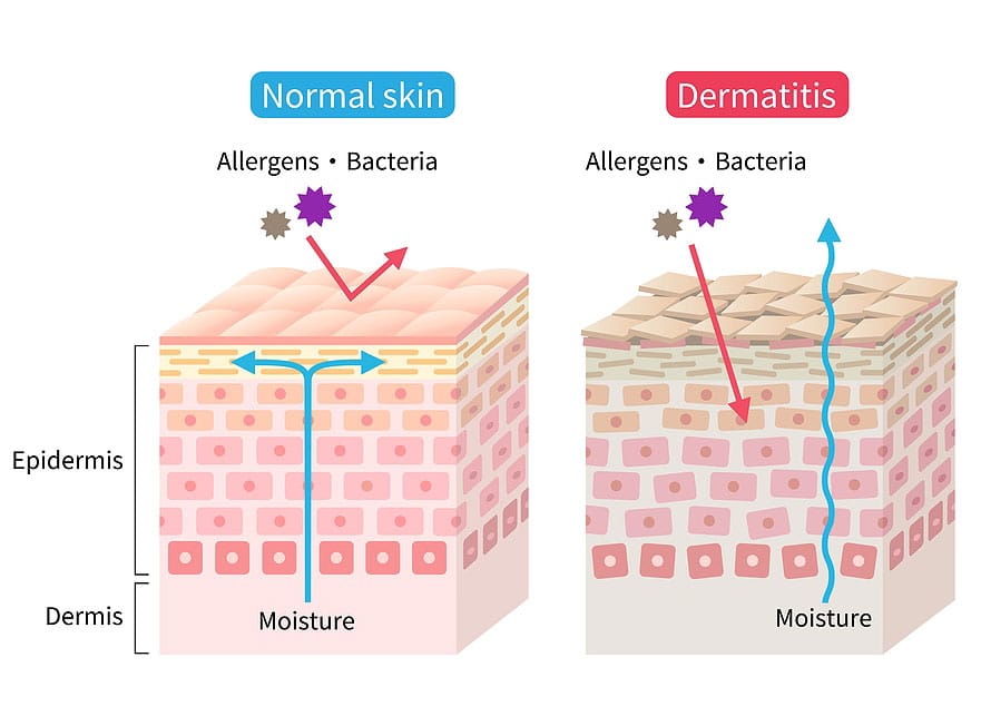 skin barrier graphic